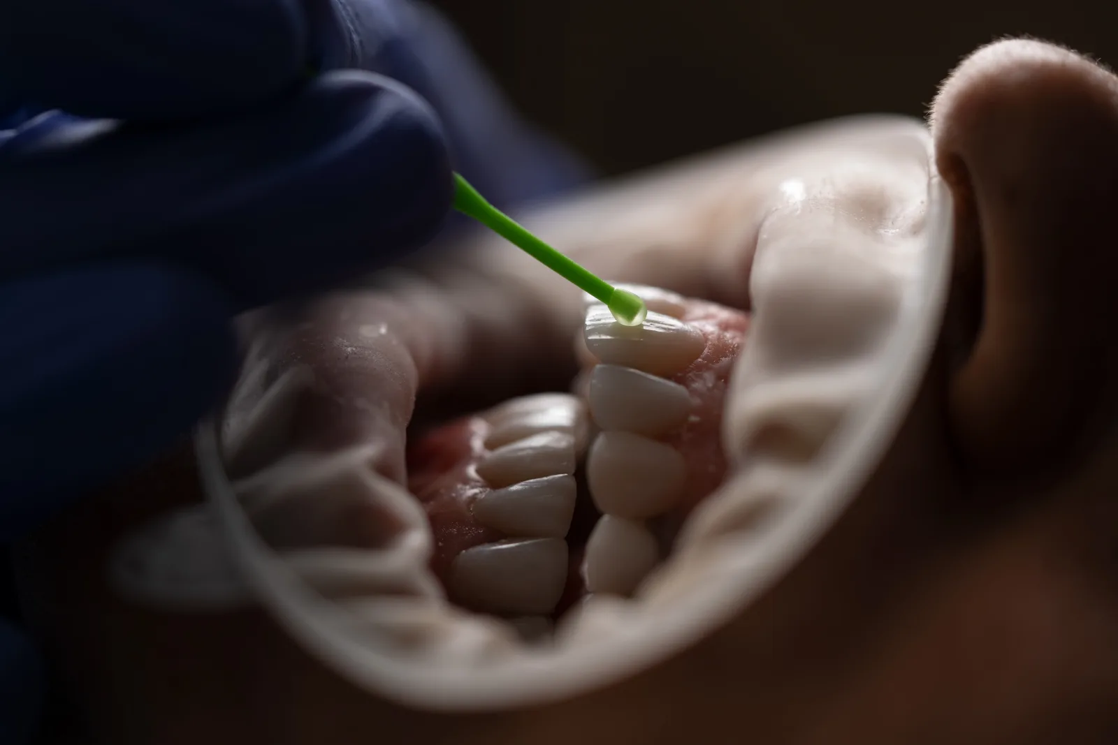 Illustrazione clinica: igiene dentale professionale