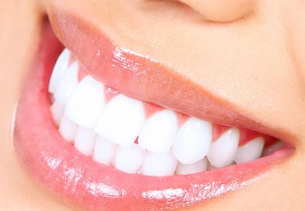 Illustrazione clinica: sbiancamento dentale