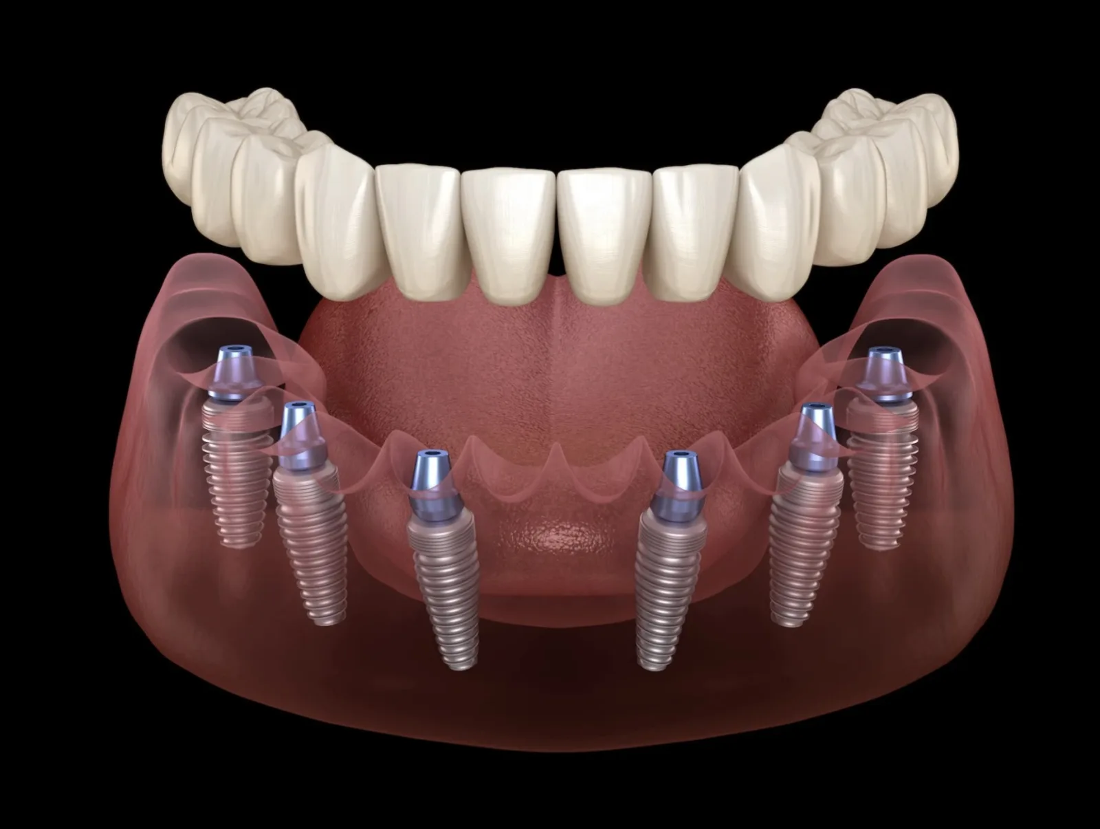 Illustrazione clinica: implantologia dentale