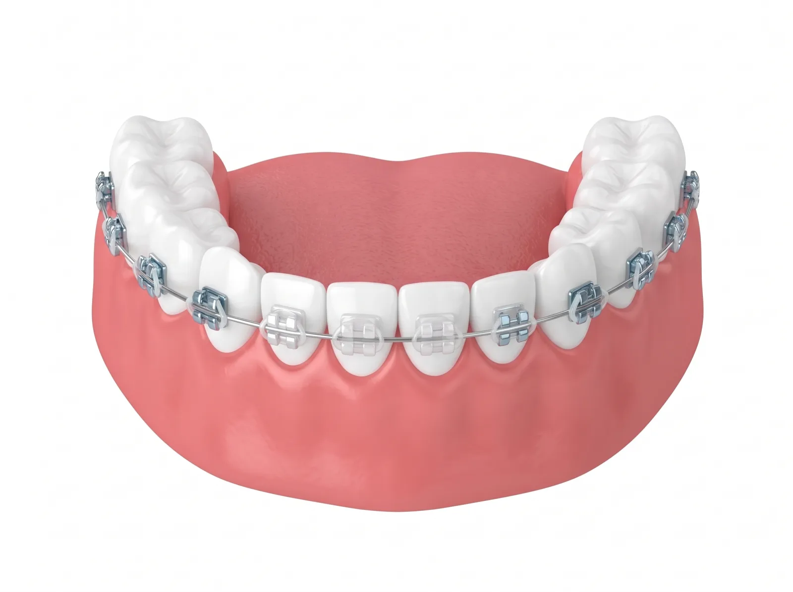 Illustrazione clinica: ortodonzia fissa