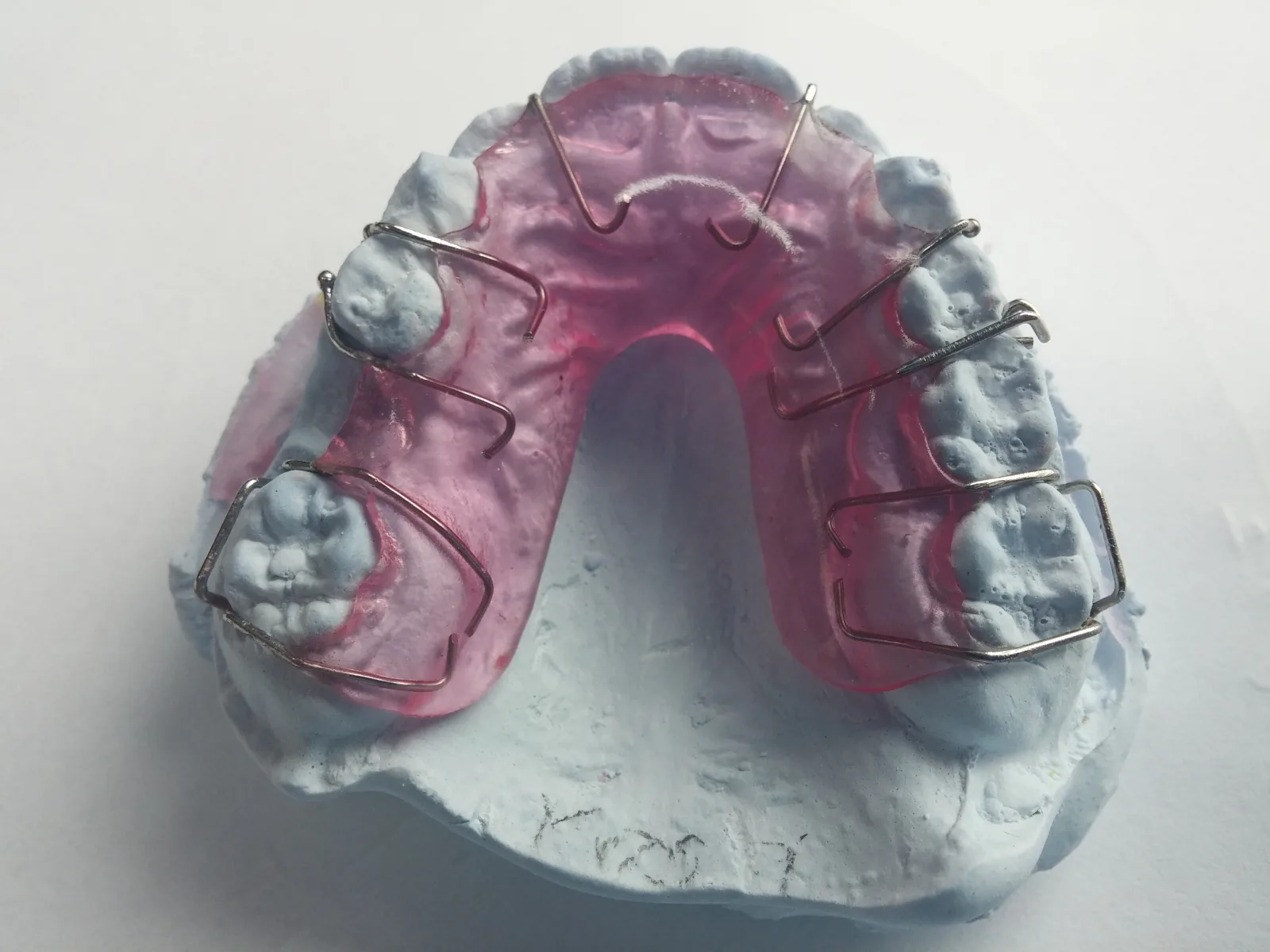 Illustrazione clinica: ortodonzia per bambini